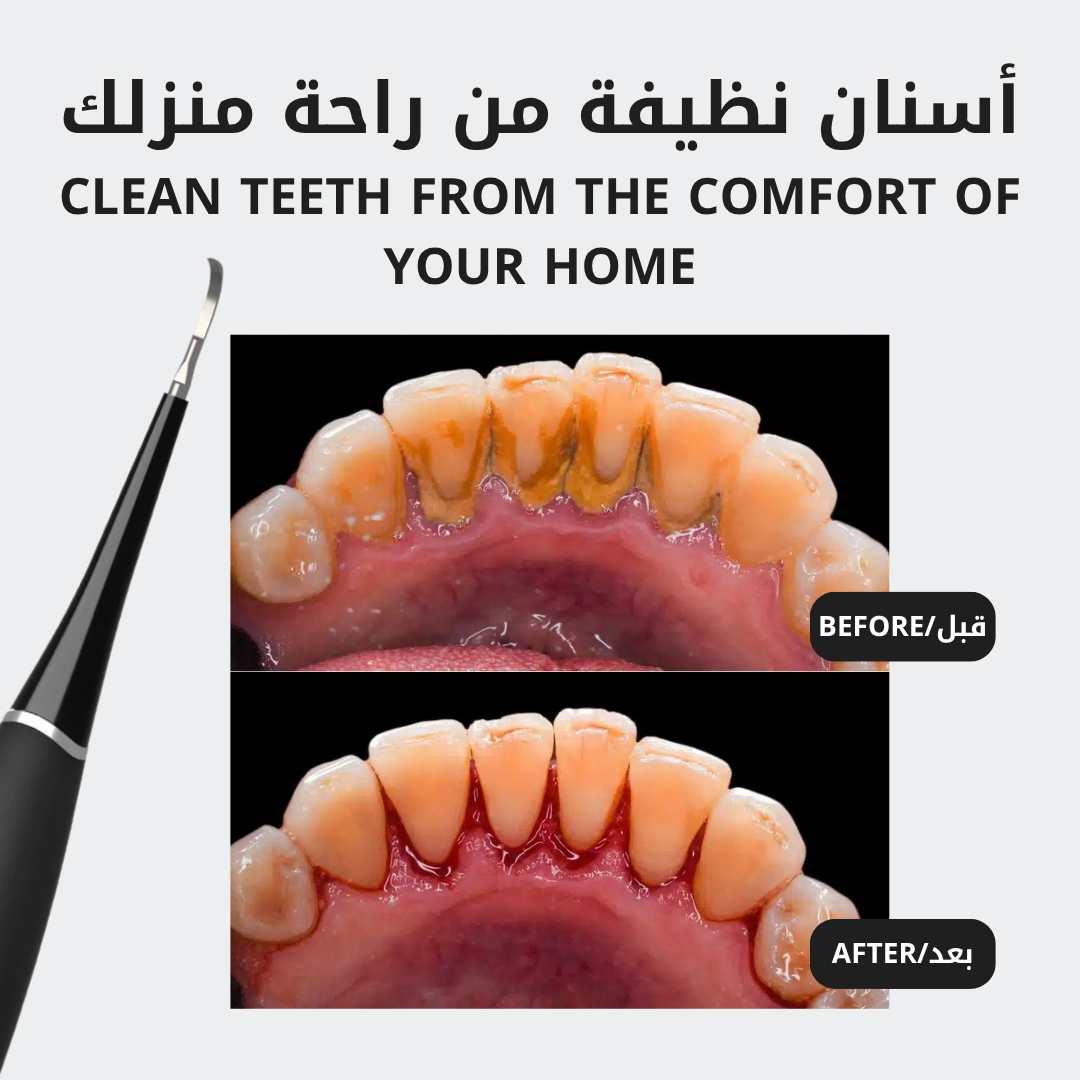 The Ultrasonic Plaque Remover