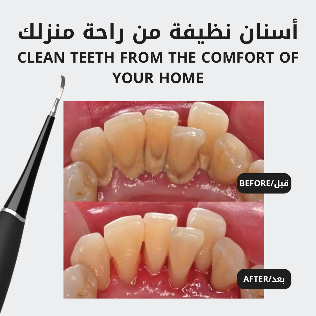 The Ultrasonic Plaque Remover