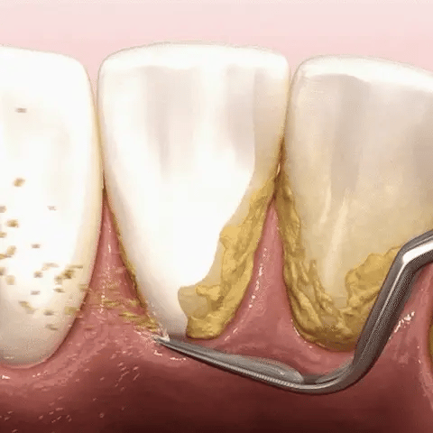 The Ultrasonic Plaque Remover