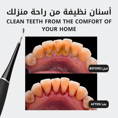 The Ultrasonic Plaque Remover