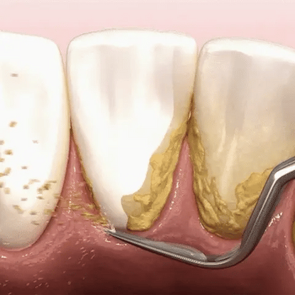 The Ultrasonic Plaque Remover